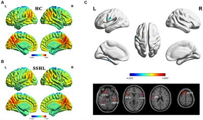 Altered static and dynamic intrinsic brain activity in unilateral sudden sensorineural hearing loss